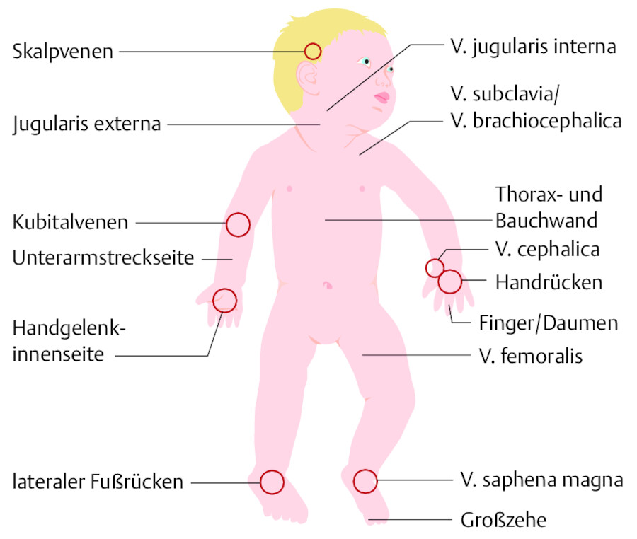 Periphere und zentrale Venenzugangsmöglichkeiten bei Kindern.