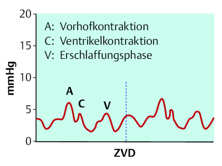 Normale ZVD-Kurve.