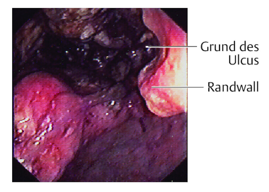 Ulkus im Bulbus duodeni.