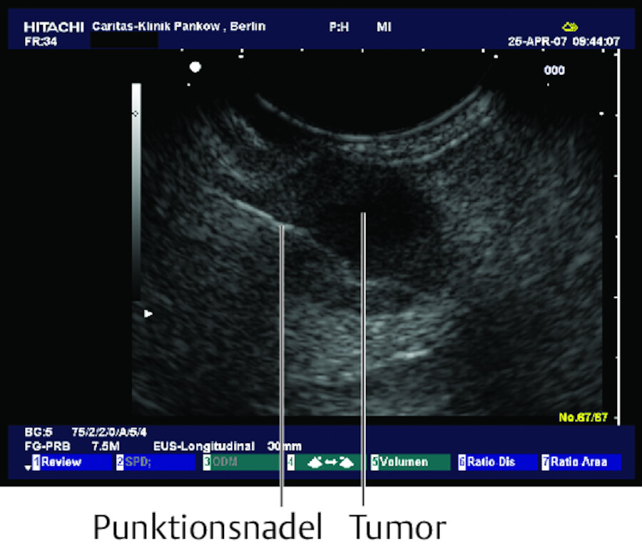 Ultraschallbild des Pankreaskopfes mit Punktion.