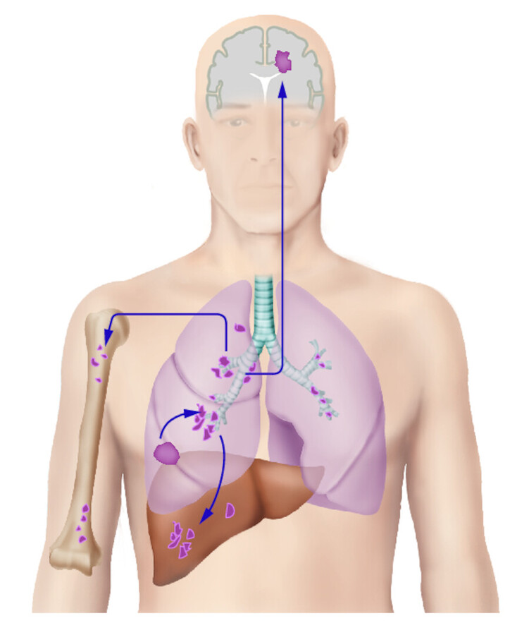 Metastasierungswege und -organe des Bronchialkarzinoms (nach Largiadèr).