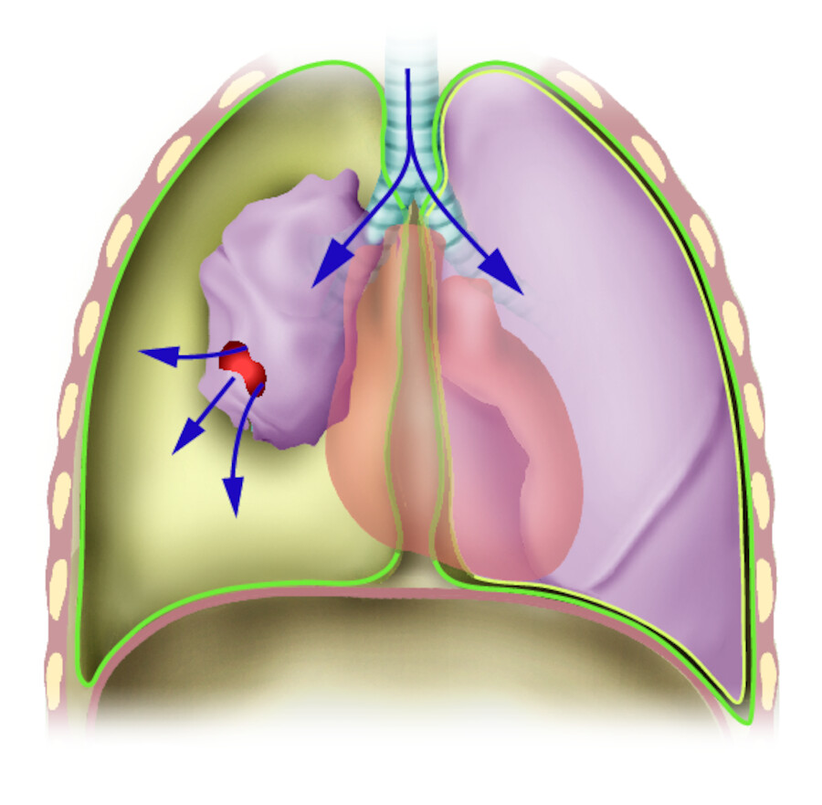 Pneumothorax.