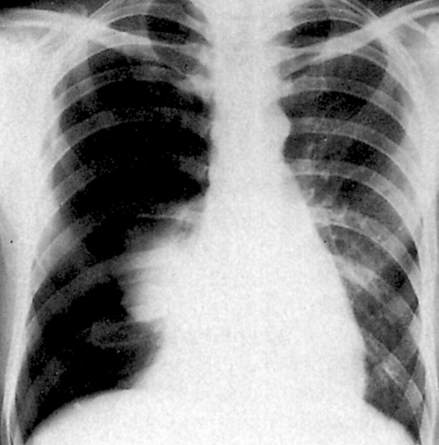 Das Röntgenbild zeigt einen rechtsseitigen Pneumothorax.