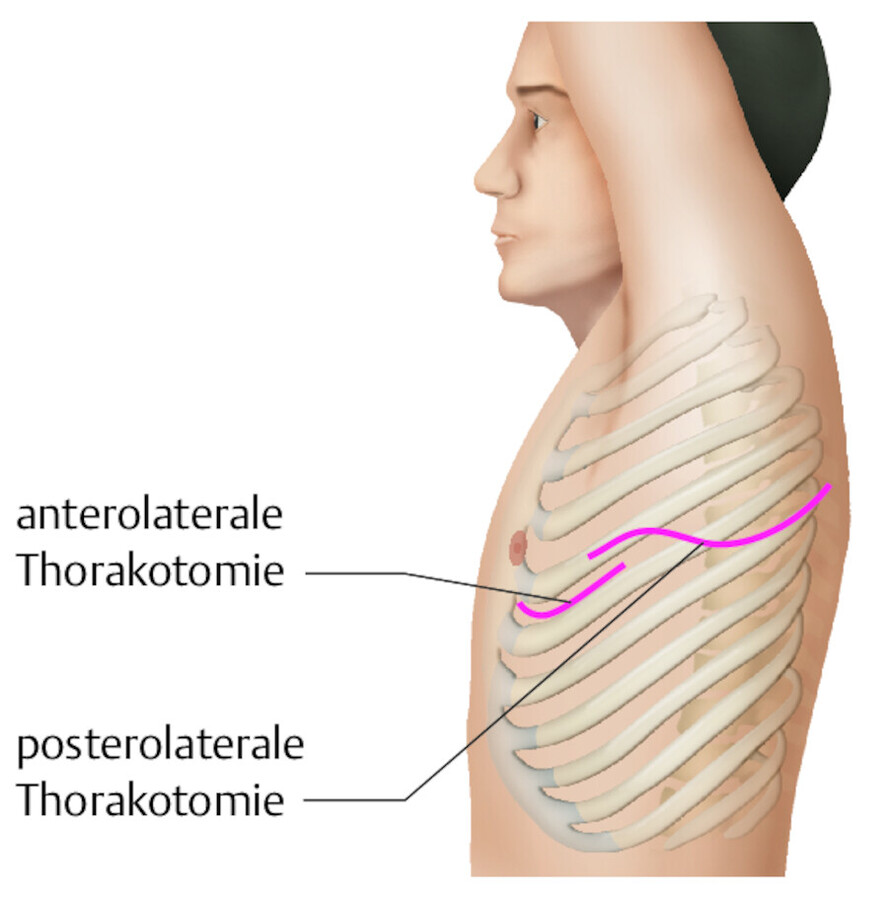 Thorakotomie.