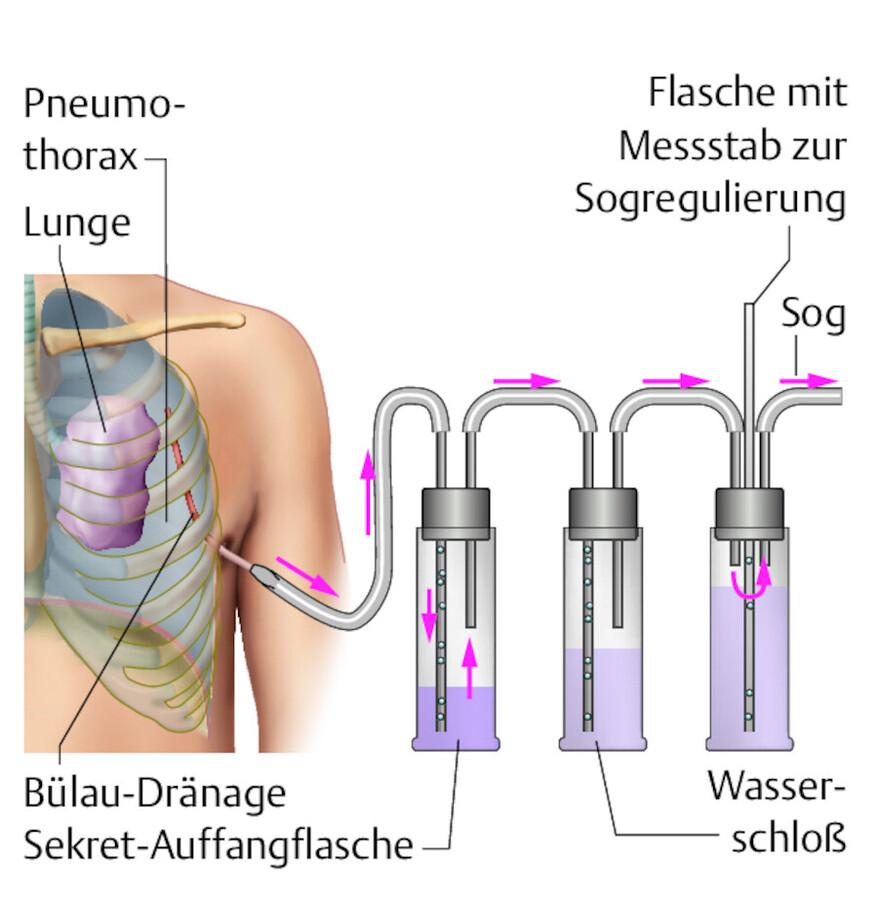 Dreiflaschensystem.