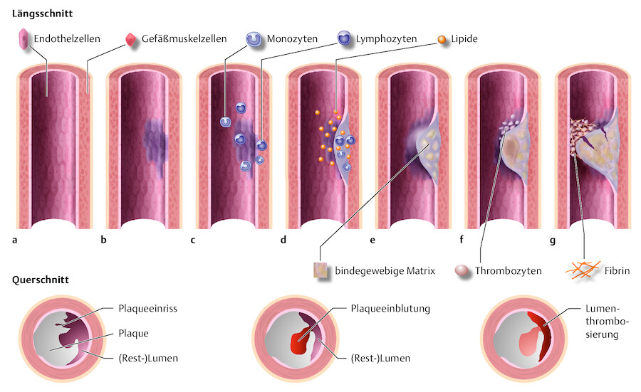 Schematische Darstellung der Atherogenese.