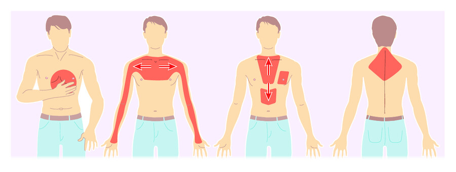 Mögliche Schmerzausstrahlung bei Angina-pectoris-Beschwerden.