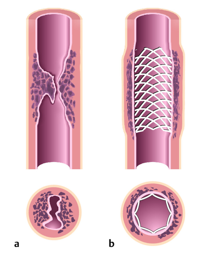 Stenteinlage.