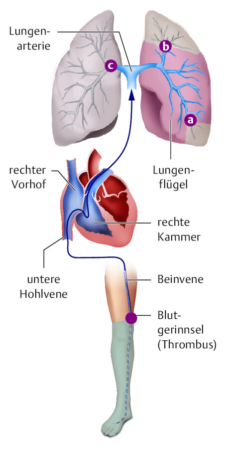 Weg des Thrombus.