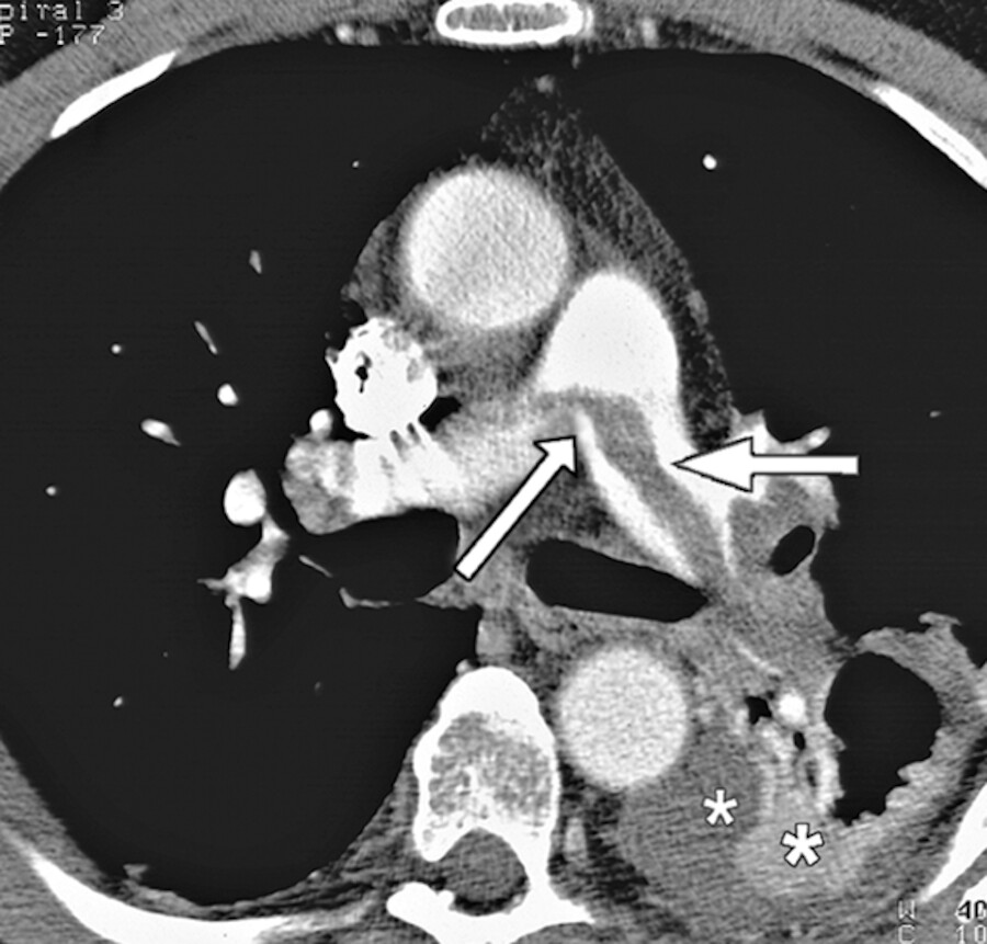 Großer Embolus auf der Aufzweigung des Pulmonalisstammes (→).