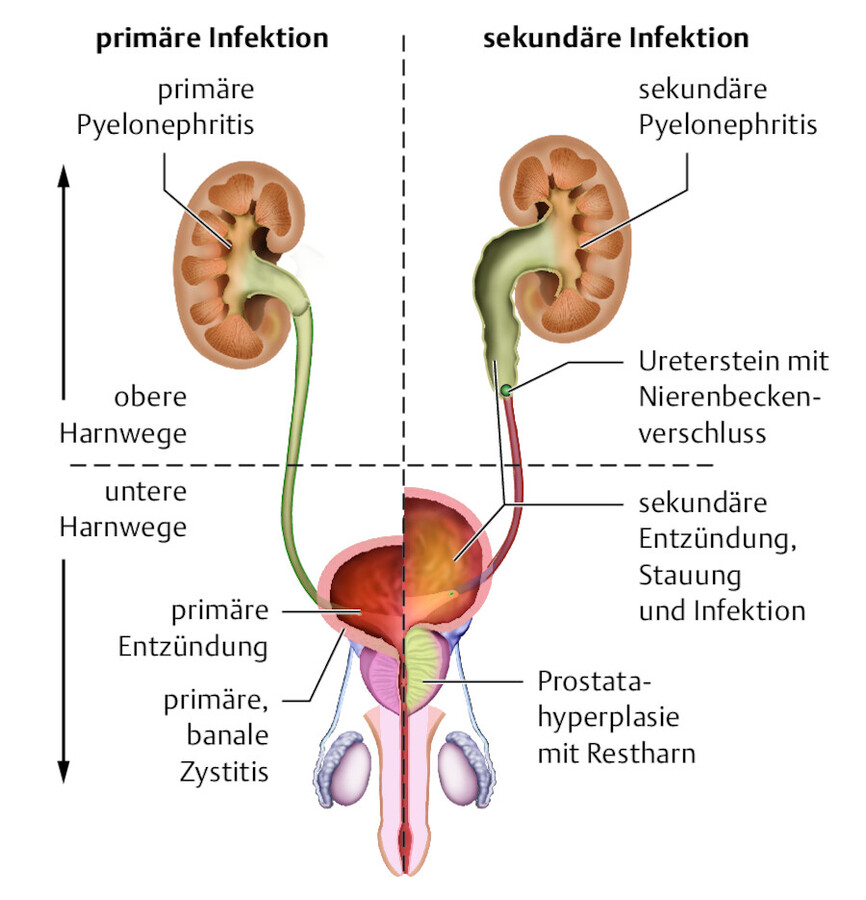 Harnwegsinfektionen werden z. B. nach Lokalisation und Entstehungsart eingeteilt.