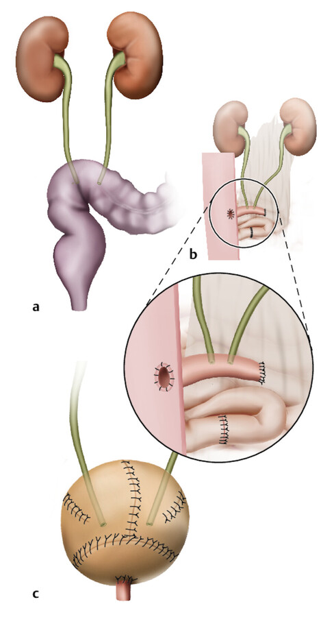 Möglichkeiten der Harnumleitung.