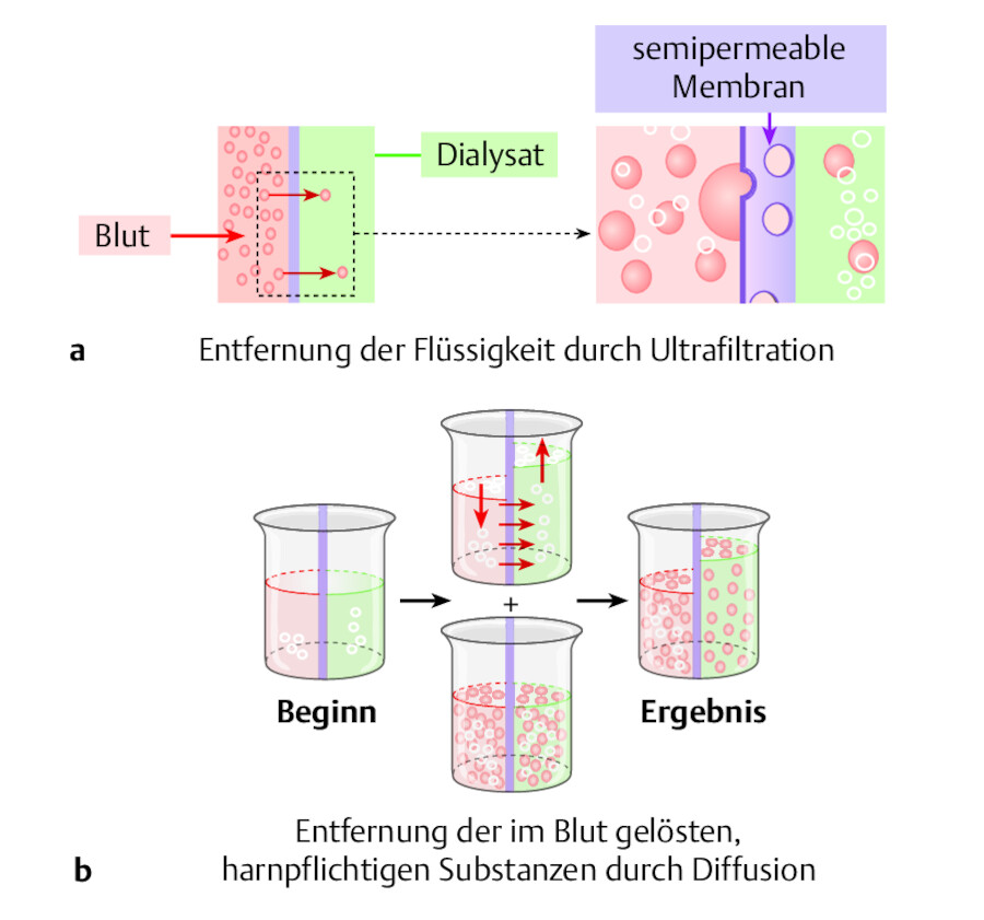 Dialyse.