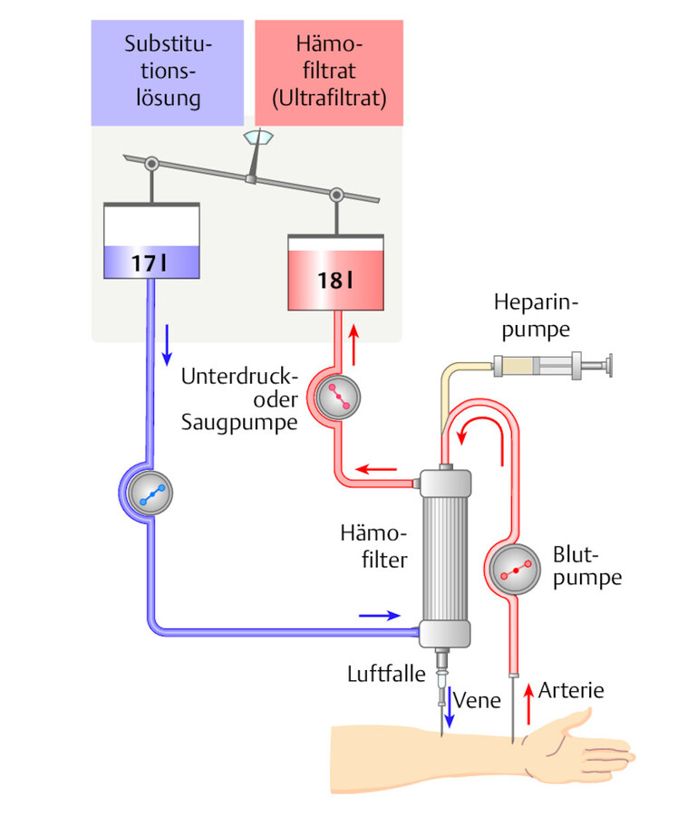 Hämofiltration.