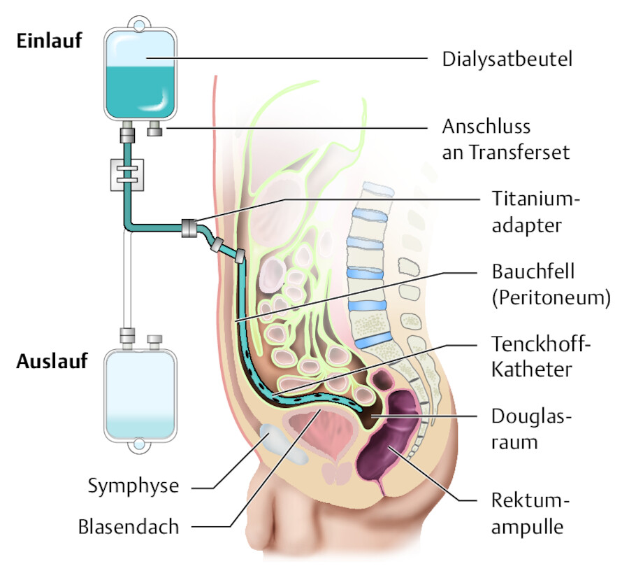 Funktionsprinzip der kontinuierlichen ambulanten Peritonealdialyse (CAPD).