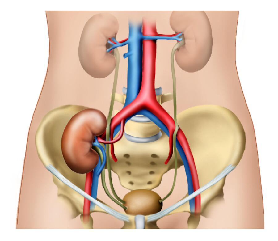 Nierentransplantation.