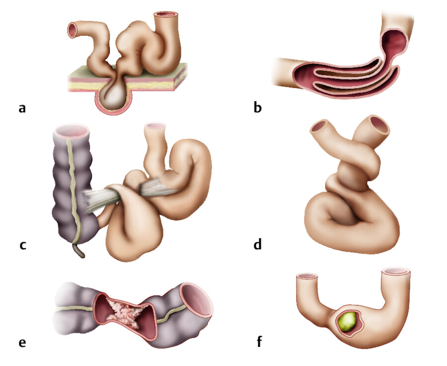 Beispiele für mechanischen Ileus.