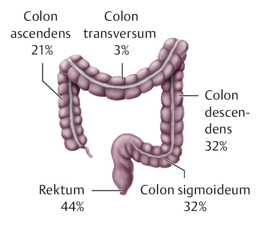 Häufigkeitsverteilung der Karzinome in Kolon und Rektum.