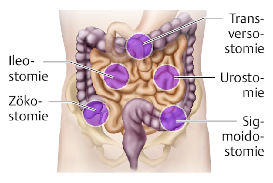 Verschiedene Lokalisationen einer Stomaanlage.