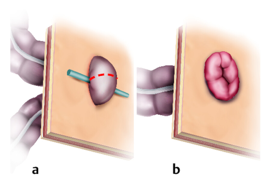 Doppelläufiges Stoma.