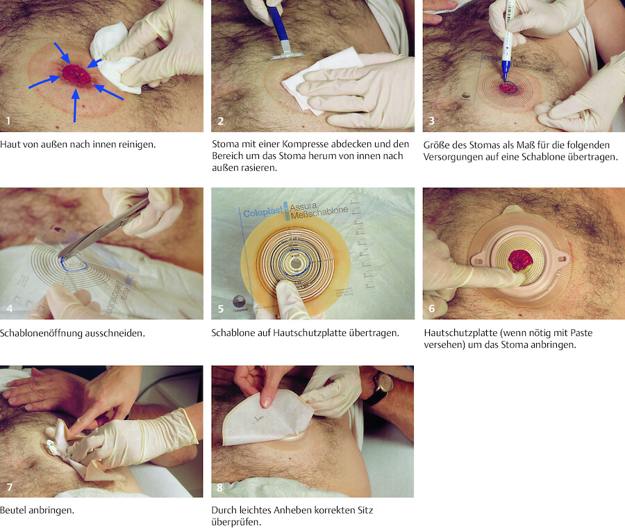 Die Fotoserie zeigt das korrekte Vorgehen bei der Versorgung eines Stomas.