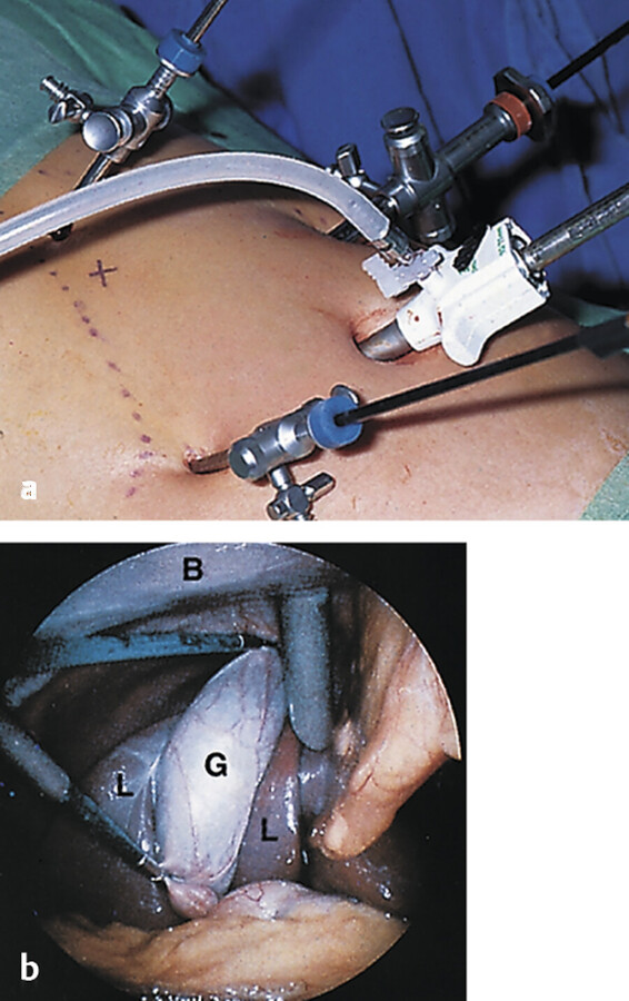 Laparoskopische Cholezystektomie.