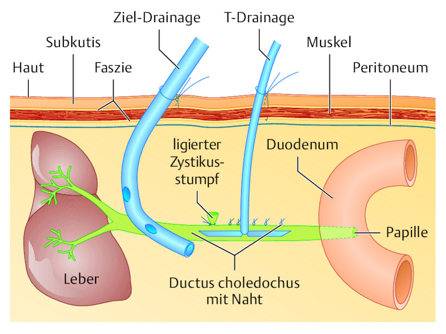 Schematischer Längsschnitt durch den Gallengang beim liegenden Patienten.