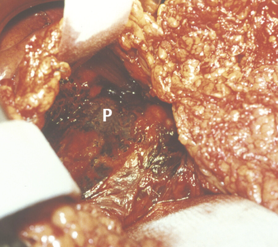 Abgestorbenes Pankreasgewebe in der Tiefe (P), rechts im Bild das große Netz.