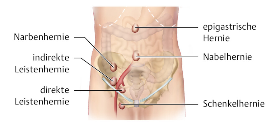 Hernien.