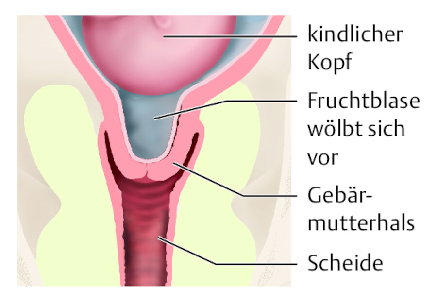 Zervixinsuffizienz.