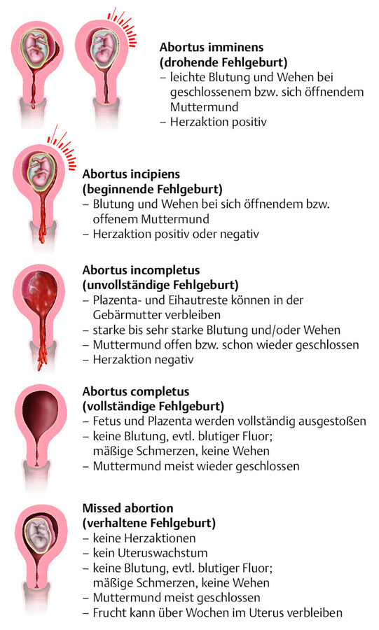 Darstellung verschiedener Abortstadien und ihrer Symptome (nach Goerke 2006).