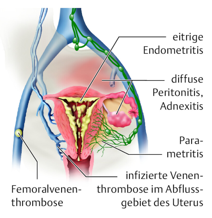 Puerperalsepsis.