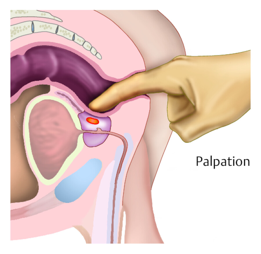 Prostatapalpation.