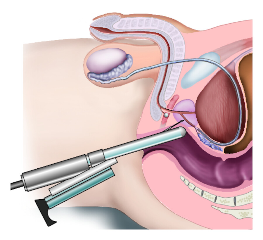 Prostatastanzbiopsie.