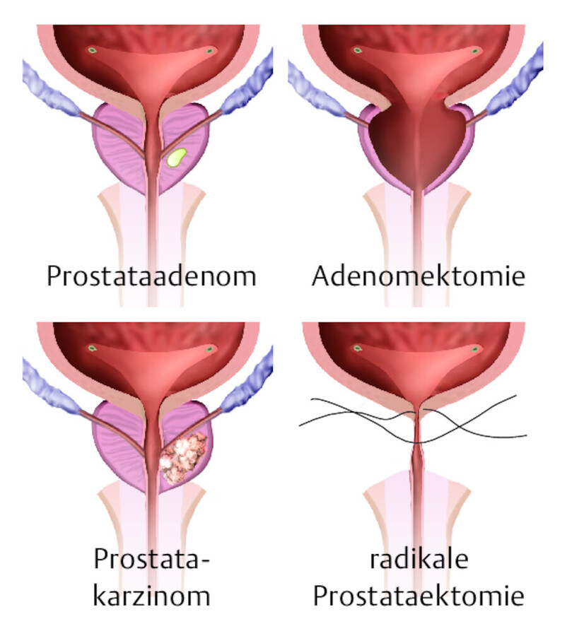 Operationen an der Prostata im Vergleich.