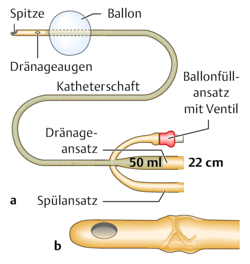 Spülkatheter.