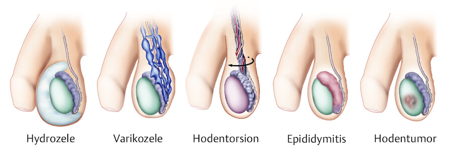 Erkrankungen an Hoden und Hodensack.