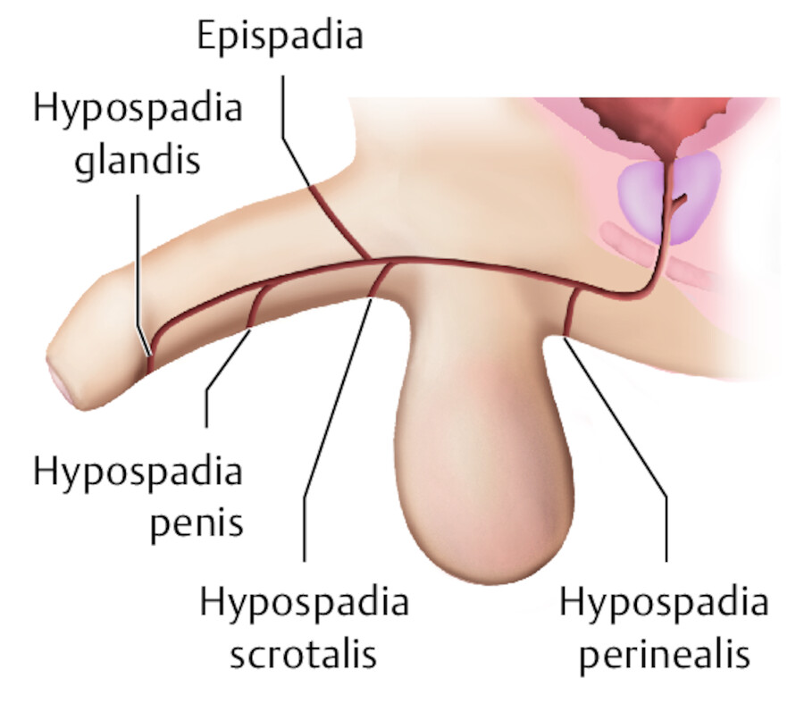 Mögliche Austrittspforten der Harnröhre bei Hypo- und Epispadie.