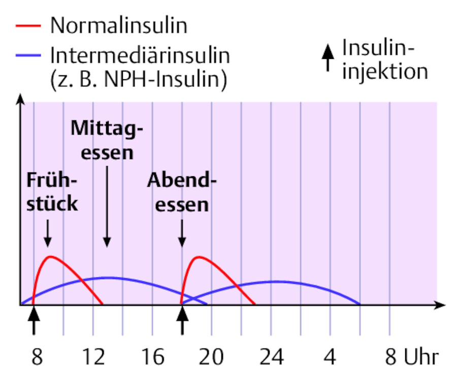 Konventionelle Insulintherapie.