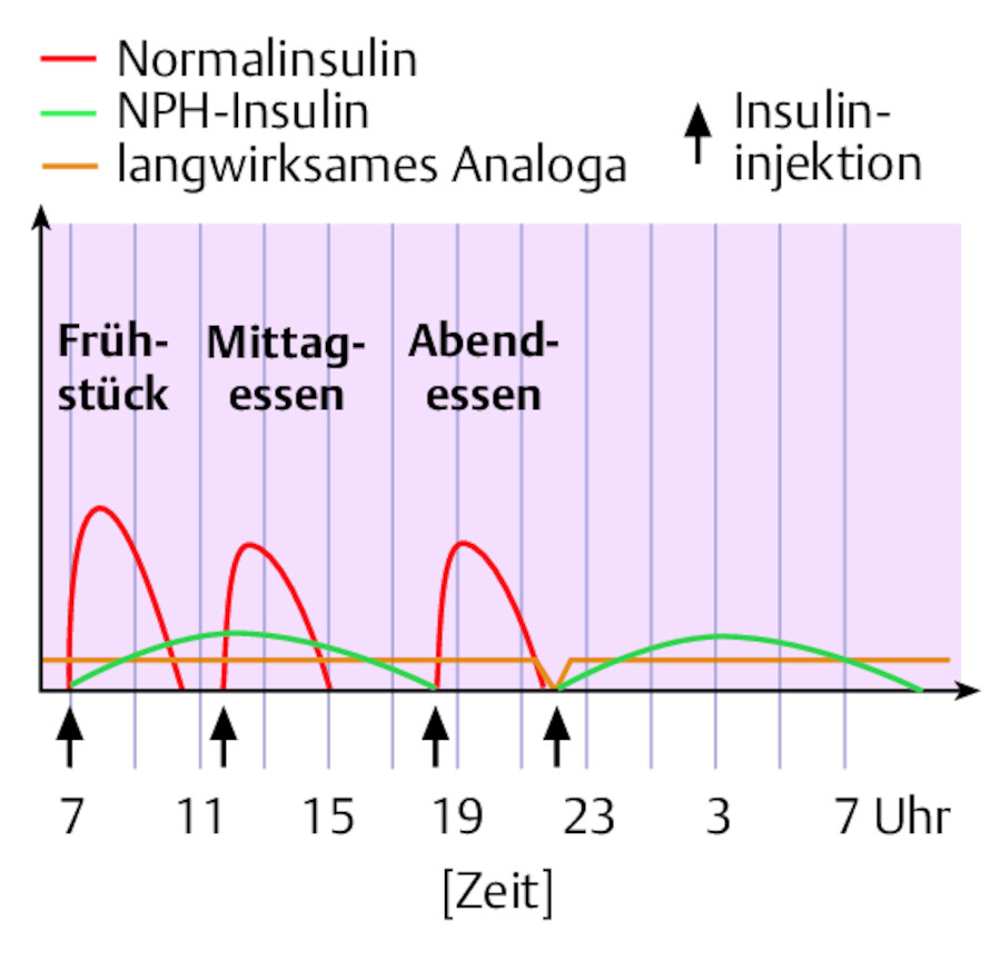 Intensivierte konventionelle Insulintherapie (ICT).