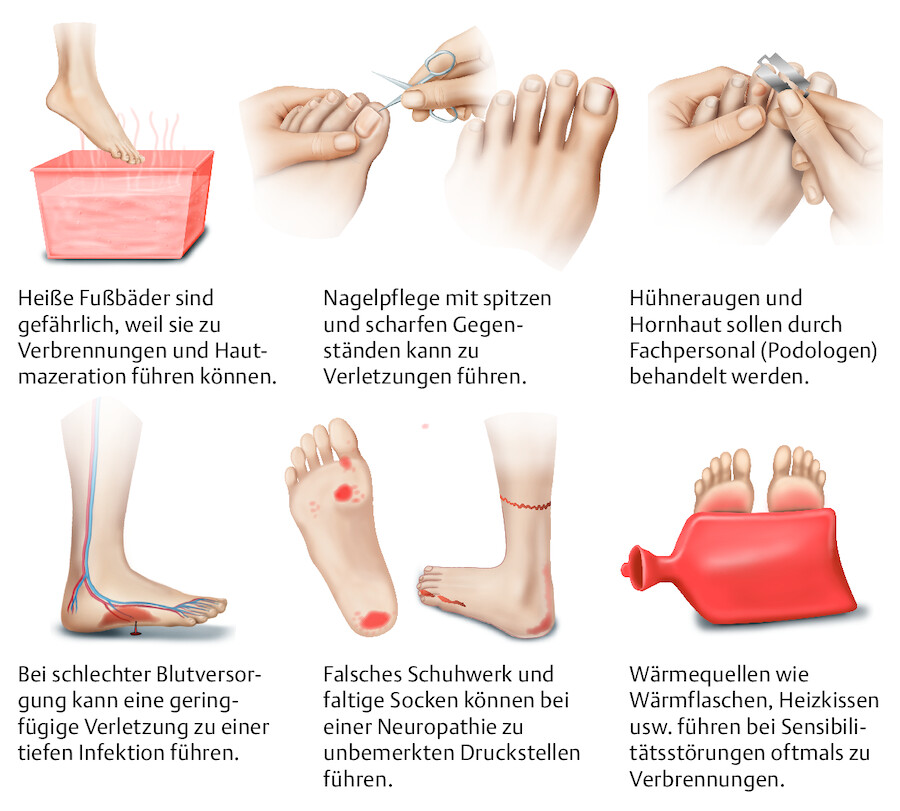 Gefahren für den Fuß bei Menschen mit Diabetes mellitus.