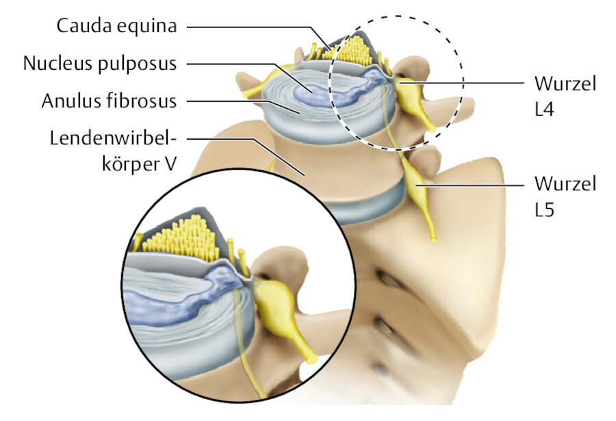Bandscheibenprolaps.