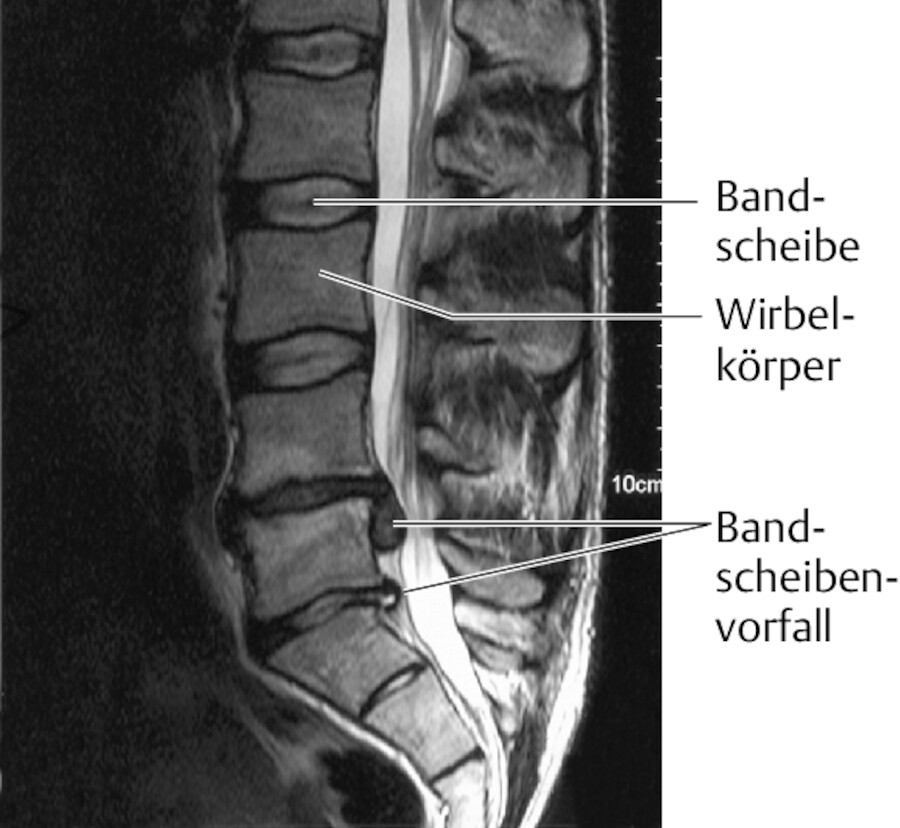 Bandscheibenvorfall.