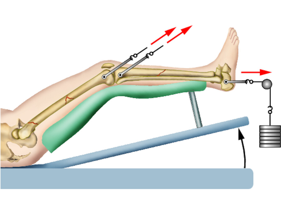 Extensionsbehandlung.