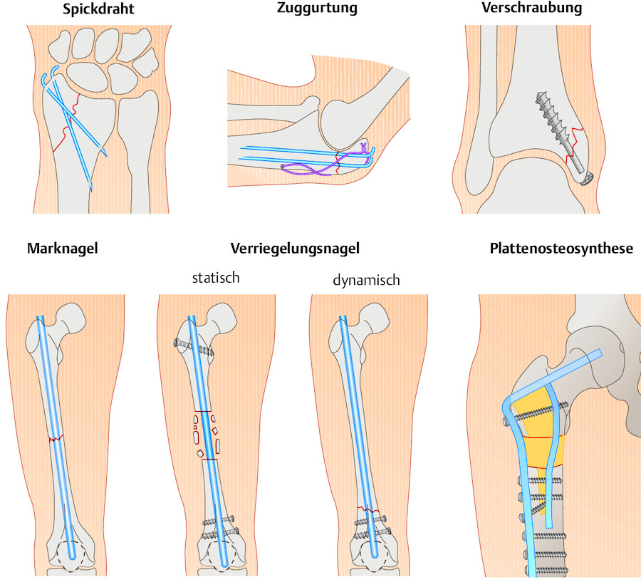 Verschiedene Osteosyntheseverfahren.