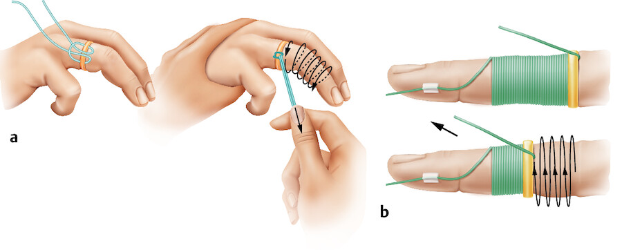 Ablösen eines Fingerrings bei Schwellung.