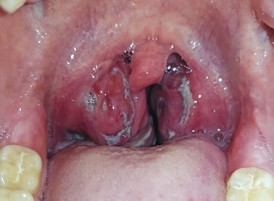 Akute Tonsillitis.