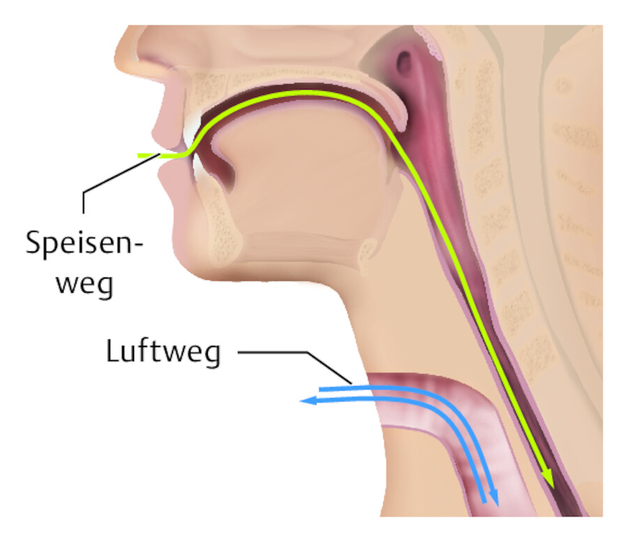 Laryngektomie.