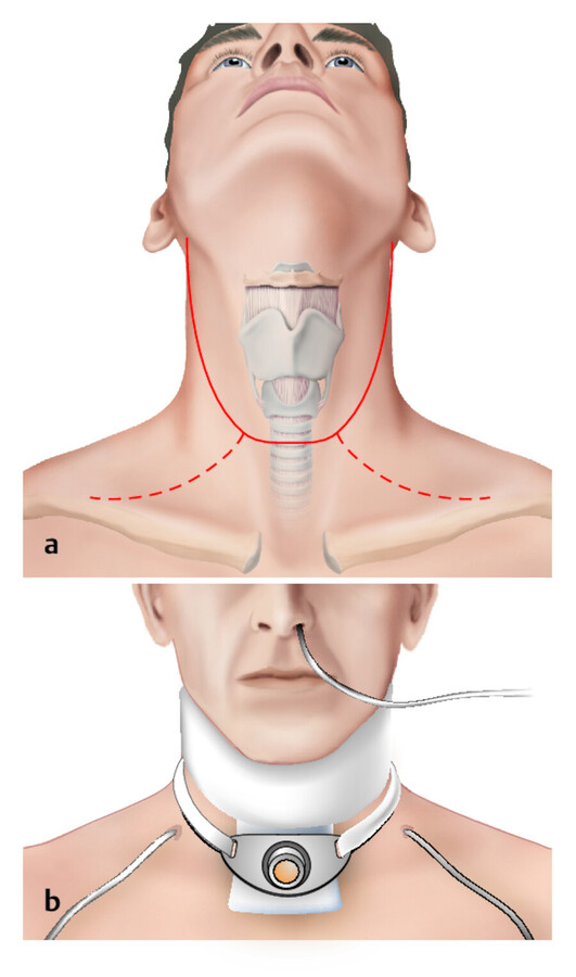 Permanentes Tracheostoma.