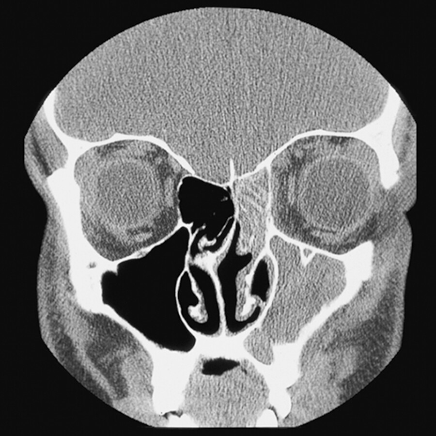 Chronische Sinusitis.